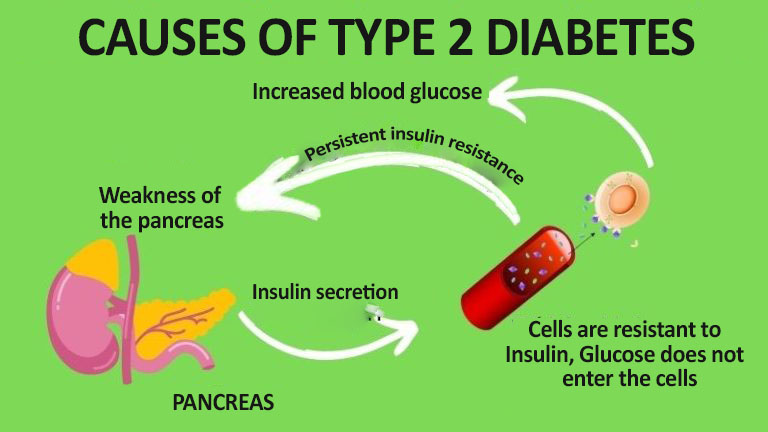 Is Type 2 Diabetes Genetic